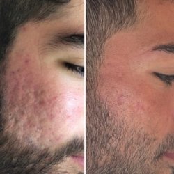 Acne Clinic