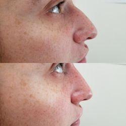 Medical Aesthetics - NON-surgical nose job
