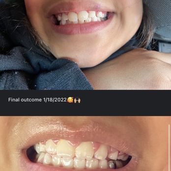 Las Vegas Braces - Day braces were removed - Orthodontists Near Me - Las Vegas, Nevada Las Vegas Braces - Day braces were removed - Orthodontists Near Me - Las Vegas, Nevada