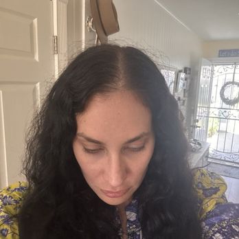 A SCALP - 3 weeks post 2nd trx and many hair washes - Hair Loss Centers Near Me