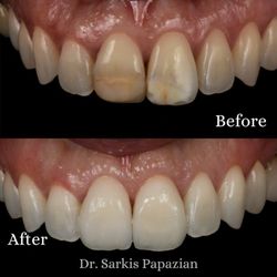 Sarkis Papazian, DDS - Transforming Smiles with Veneers: