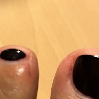 Pro Nail Spa - Toe injury from horrible pedicure - Nail Salons Near Me - Chula Vista, California