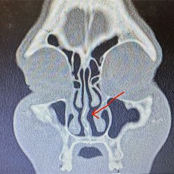 John Minoli MD FACS Las Vegas Cosmetic Surgery - CT Scan at roughly four months postop showing septum remained deviated- red arrow.