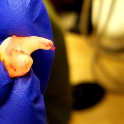 Riverside Tooth Co. - Just had my first wisdom tooth removed & you can even see the nerves attached! I DIDN'T FEEL A THING!!!   Dr. Z is A-MA-ZING!!! 06/09/17