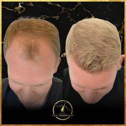 Miami Hair Transplant