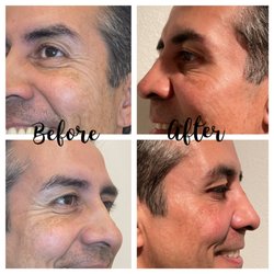Botox is suitable for men and women