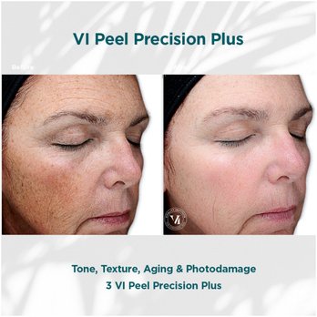 Integralife Spa - Safe & comfortable Chemical peels - Skin Care Near Me - Fort Myers, Florida Integralife Spa - Safe & comfortable Chemical peels - Skin Care Near Me - Fort Myers, Florida