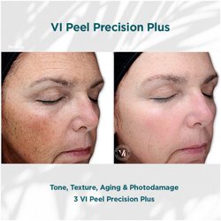 Integralife Spa - Safe & comfortable Chemical peels