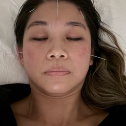 Acupuncture for sinuses!