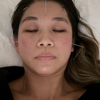 Chosen Acupuncture - Acupuncture for sinuses! - Acupuncture Near Me - Rosemead, California