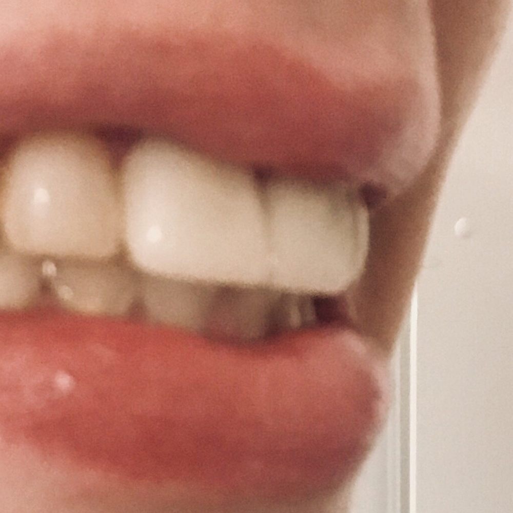 Eric George, DMD & Associates - Front permanent crowns too big for my mouth and extremely uncomfortable for my bite - General Dentistry Near Me - Coventry, Rhode Island Eric George, DMD & Associates - Front permanent crowns too big for my mouth and extremely uncomfortable for my bite - General Dentistry Near Me - Coventry, Rhode Island