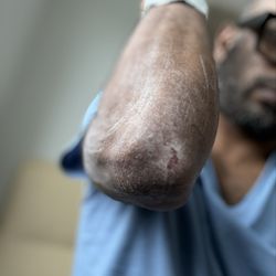 Suburban Hospital - Allergic reaction due to mistreatment/illogical reasoning/nonsense treatment