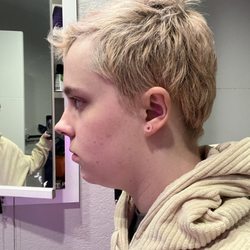 Raval Facial Aesthetics and Rocky Mountain Laser Aesthetics - Before