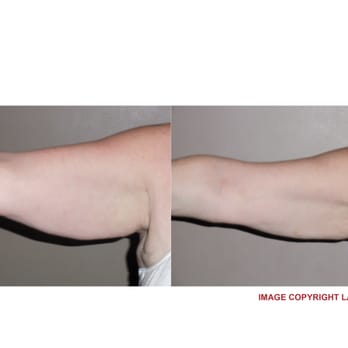 LiLa Body Contouring - Lost a cumulative 3 inches of fat after 6 sessions - Body Contouring Near Me - Englewood, Colorado LiLa Body Contouring - Lost a cumulative 3 inches of fat after 6 sessions - Body Contouring Near Me - Englewood, Colorado