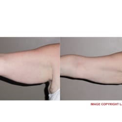 LiLa Body Contouring - Lost a cumulative 3 inches of fat after 6 sessions
