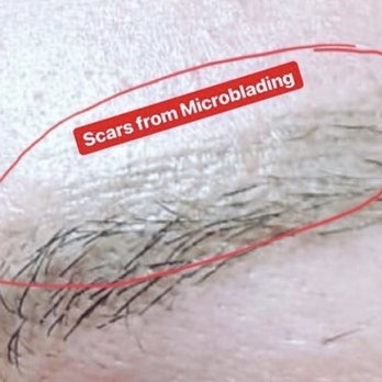 Willow Med Spa & Salon - Scars from microblading - Medical Spas Near Me - Morgantown, West Virginia Willow Med Spa & Salon - Scars from microblading - Medical Spas Near Me - Morgantown, West Virginia