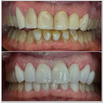 Kord Dentistry - Before: 30 year old veneers and After: new veneers - Orthodontists Near Me - Mission Viejo, California Kord Dentistry - Before: 30 year old veneers and After: new veneers - Orthodontists Near Me - Mission Viejo, California