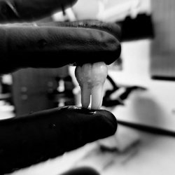 Howe Dental Associates - Extraction of a pretty molar