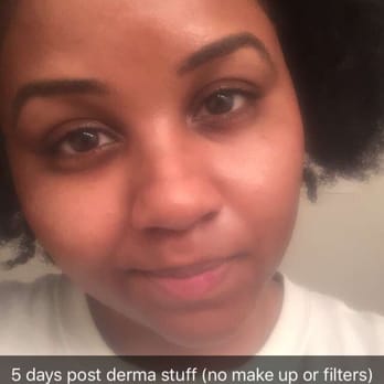 Face 2 Face Spa Studio - 5 days after dermaplaing and microdermabrasion - Makeup Artists Near Me - Berwyn, Illinois