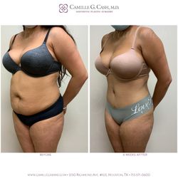 Camille Cash, M.D - Before and 6 weeks after a tummy tuck with 360 lipo