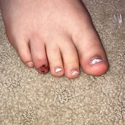 Cut up toe