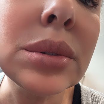 Bella Aesthetics - March 2025 this was taken 2 hours after the procedure - Cosmetics & Beauty Supply Near Me - Rancho Cucamonga, California