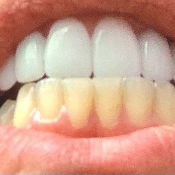 Forever Flawless Permanent Cosmetics - My Before! I had to get all my top teeth capped, and they did not match my bottom natural teeth. - Permanent Makeup Near Me - Kennewick, Washington Forever Flawless Permanent Cosmetics - My Before! I had to get all my top teeth capped, and they did not match my bottom natural teeth. - Permanent Makeup Near Me - Kennewick, Washington