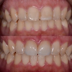 My Plantation Dentist - Heidi R Finkelstein, DMD - Smile transformation - conservative, cosmetic crowns!