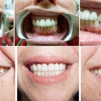 Aesthetics & Essentials Dental Group - The top picture is the before (another dentist's work) and the bottom pictures is the After picture (Dr. Habibi's work). - General Dentistry Near Me - Mountain View, California Aesthetics & Essentials Dental Group - The top picture is the before (another dentist's work) and the bottom pictures is the After picture (Dr. Habibi's work). - General Dentistry Near Me - Mountain View, California