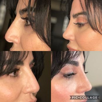 Vladimir Grigoryants, MD - Before and After - Cosmetic Surgeons Near Me - Glendale, California Vladimir Grigoryants, MD - Before and After - Cosmetic Surgeons Near Me - Glendale, California