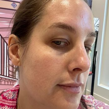 LaserAway - After - Tattoo Removal Near Me - Washington DC, District of Columbia