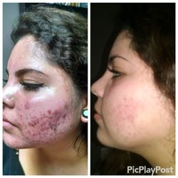 Derm by Erica - Amazing transformation