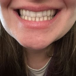 My teeth after my treatment! My teeth after my treatment!