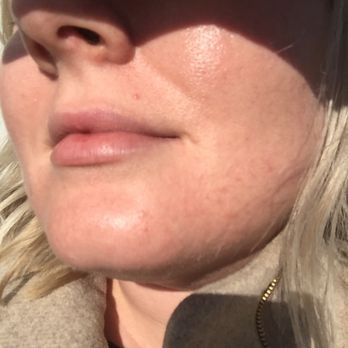 Atlantic Dermatology Associates, PC - Before... - Dermatologists Near Me - Virginia Beach, Virginia