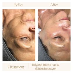 Bliss Beauty Bar - Firm, lift & deeply hydrate your skin. This facial experience goes beyond Botox - designed to reduce the appearance of fine lines & wrinkles