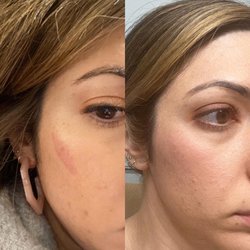 Before/After  LED Red Light Treatment reduces scarring.