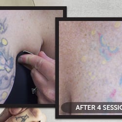 Indy Laser Tattoo Removal