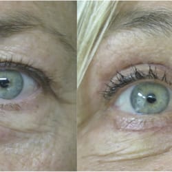 FacebyDrH - Upper and Lower Blepharoplasty (Eye Lift) with fat repositioning (after photos are 2 weeks post op!)