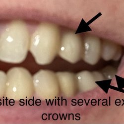 Hickory Plaza Dental Group - Bite on the opposite side. Normal and natural bite with crowns from dentist in previous state of residence.