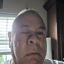 I swollen shut from cancer removal, extreme pain