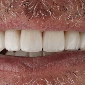 Advanced Dentistry of Amarillo - Smile restoration by Dr. Miller - Cosmetic Dentists Near Me - Amarillo, Texas Advanced Dentistry of Amarillo - Smile restoration by Dr. Miller - Cosmetic Dentists Near Me - Amarillo, Texas