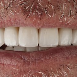 Smile restoration by Dr. Miller