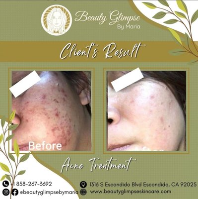 Acne Treatment - This is the result of her 4 session Acne Treatment with Beauty Glimpse by Maria home care regimen. The scarring from the before pic was almost gone. Her skin is glowing, healthy and nearly pimple-free.
Acne treatment is not an overnight progress. Results takes time, consistency and sometimes trial and error. But with the right guidance, home care products and treatments you'll be well on your way for progress. Acne Treatment - This is the result of her 4 session Acne Treatment with Beauty Glimpse by Maria home care regimen. The scarring from the before pic was almost gone. Her skin is glowing, healthy and nearly pimple-free.
Acne treatment is not an overnight progress. Results takes time, consistency and sometimes trial and error. But with the right guidance, home care products and treatments you'll be well on your way for progress.