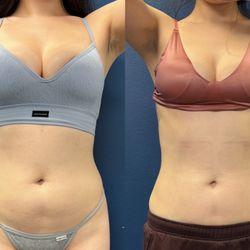 Bare Fruit Body Lab - 3 Lipo Cavitation and lymphatic Drainage  sessions