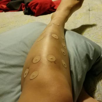 Brian Li - Magnetic treatment for help with circulation. - Acupuncture Near Me - Diamond Bar, California Brian Li - Magnetic treatment for help with circulation. - Acupuncture Near Me - Diamond Bar, California