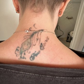 LaserXX - After 1 session - Tattoo Removal Near Me - Los Angeles, California LaserXX - After 1 session - Tattoo Removal Near Me - Los Angeles, California
