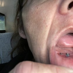 Gross & Flores, DDS - Exposed implant didn't stitch correctly.