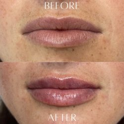 Avail Aesthetics - Before and After Lip Filler by Kelly Smith, NP at Avail Aesthetics Cary