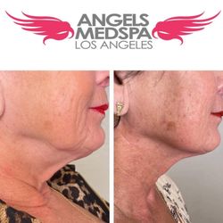 Angels Med Spa Los Angeles - Plasma pen Fibroblast skin tightening to neck