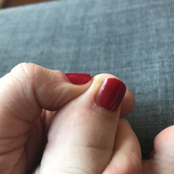 Palace Nails & Spa - Toenail left untreated properly - Nail Salons Near Me - Philadelphia, Pennsylvania Palace Nails & Spa - Toenail left untreated properly - Nail Salons Near Me - Philadelphia, Pennsylvania